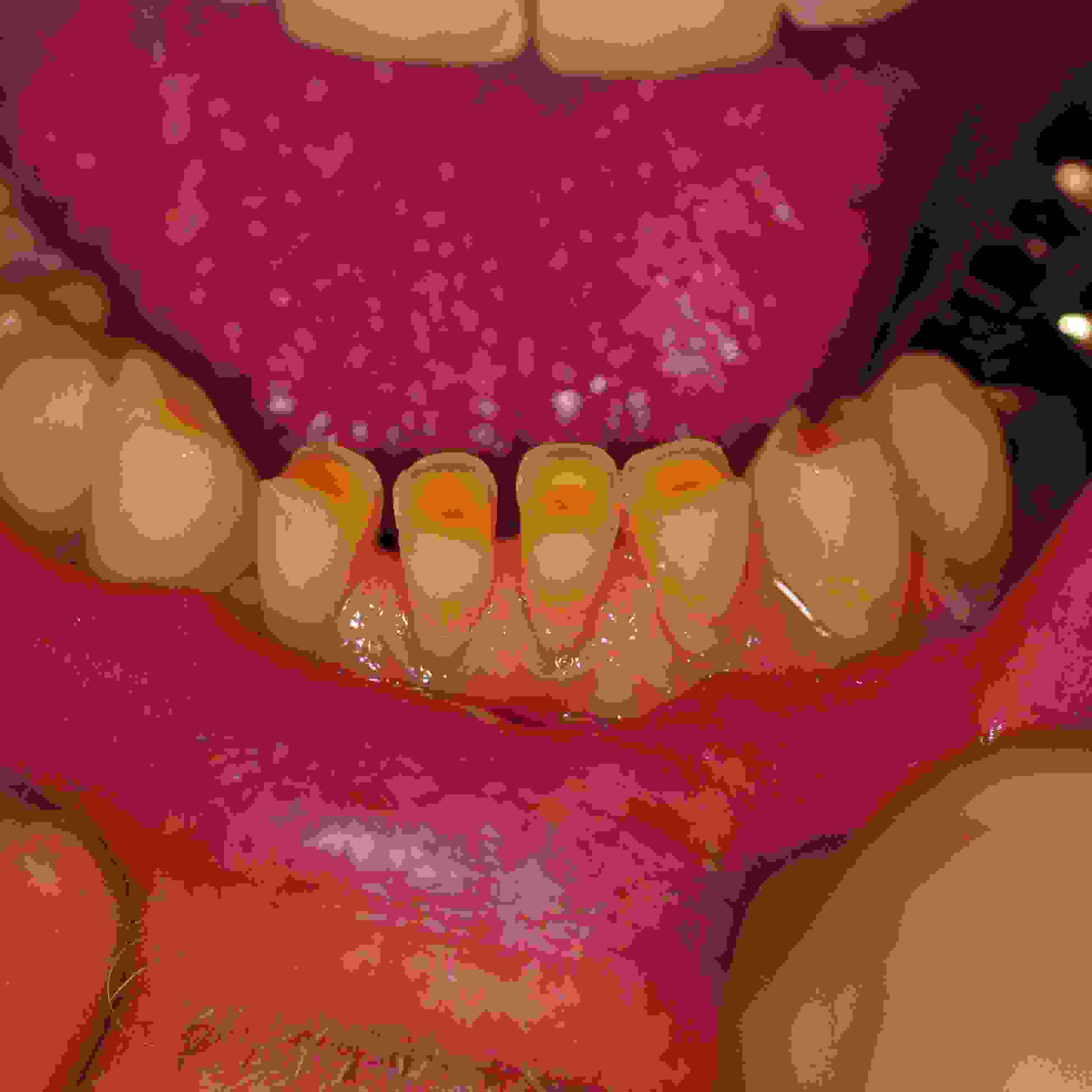 Worn front teeth