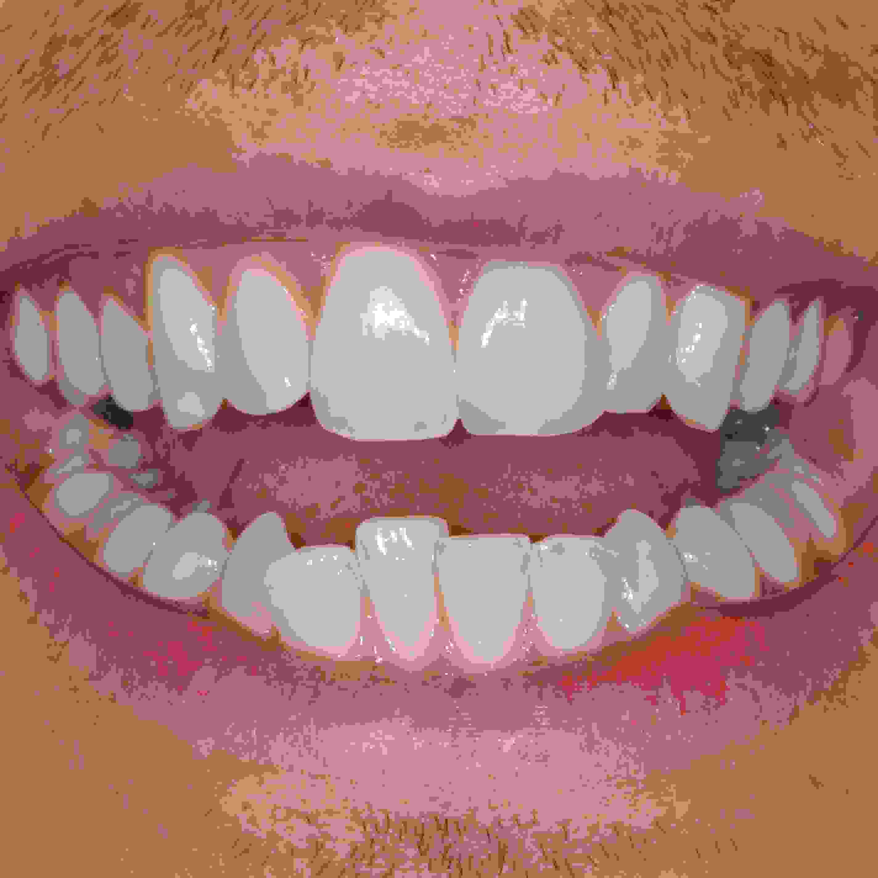 Lower teeth before