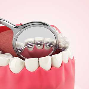 Image of Lingual braces